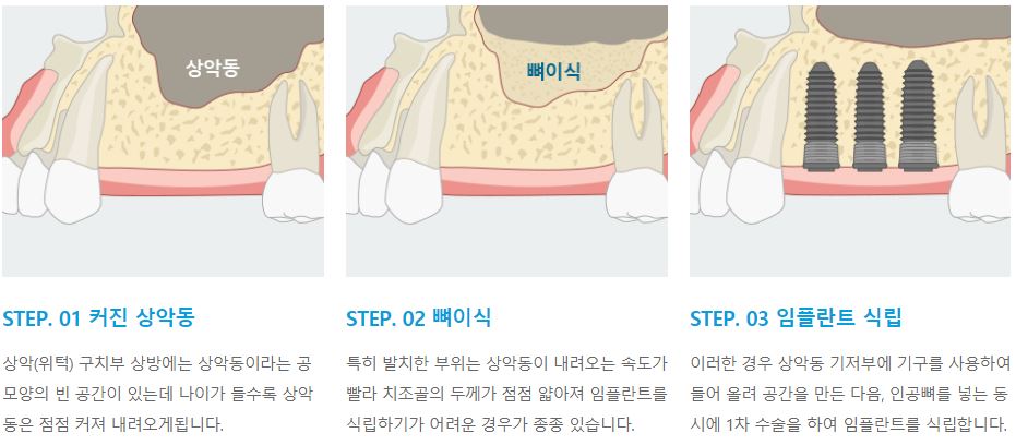 뼈이식 임플란트, 튼튼한 뼈는 임플란트 성공의 핵심 [에스플란트 치과병원] 관련 이미지 5