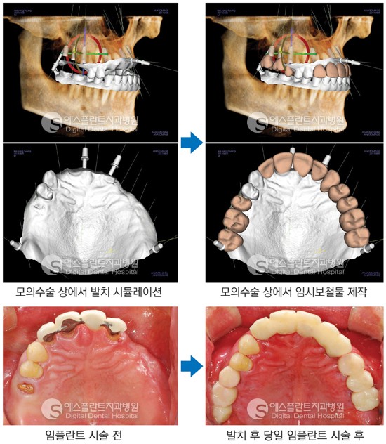 [CT임플란트] 3D CT 임플란트, 아나토마지 가이드 임플란트 관련 이미지 4