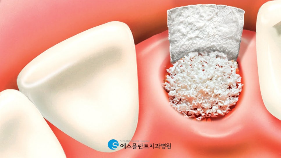 청담 뼈이식임플란트, 안전하고 편안하게 받는 법 관련 이미지 2