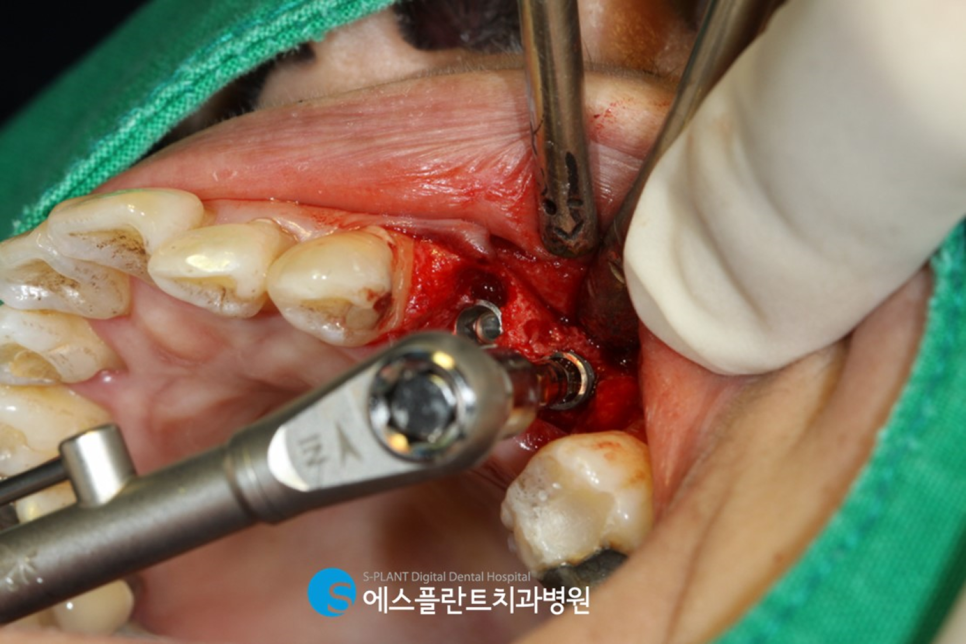 강남치과 에스플란트치과병원의 자가혈 임플란트(PRF)로 높은 성공률과 빠른 회복 관련 이미지 5