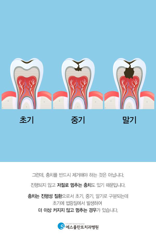 올바른 치과 문화 만들기(충치) Step1. 관련 이미지 3
