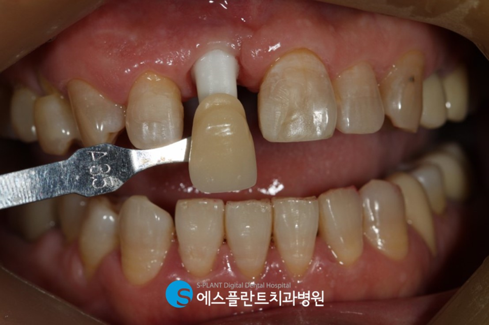 앞니 임플란트 잘하는 강남 에스플란트치과병원에서 내 치아처럼! (feat. 지르코니아 심미 임플란트 보철물) 관련 이미지 6