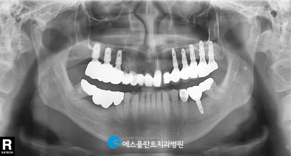 강남임플란트 잘하는 치과 에스플란트 병원의 오래된 브릿지 제거 후 임플란트 관련 이미지 2