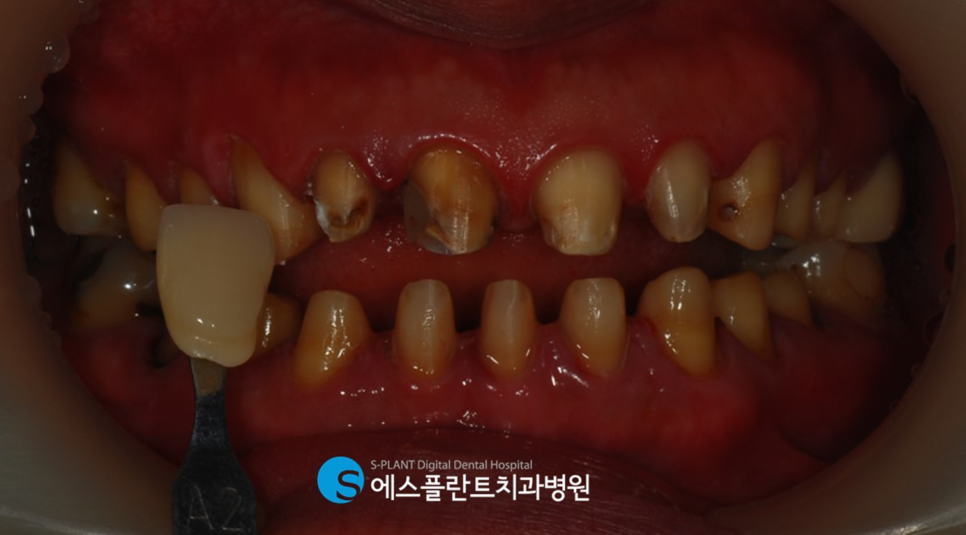압구정 심미보철 치과, 에스플란트치과병원에서 치아를 예쁘고 가지런하게 관련 이미지 5
