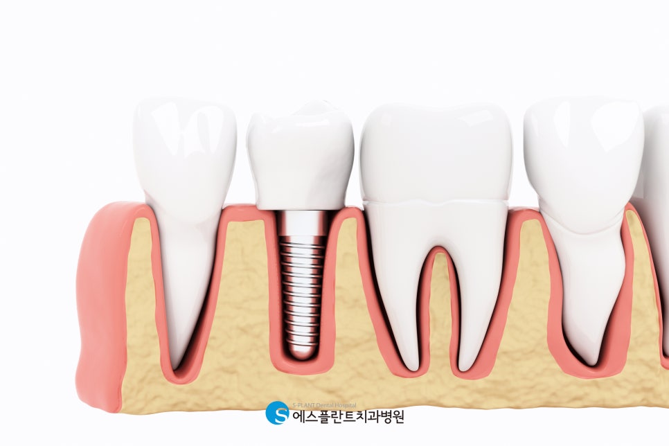 Gangnam Implant, Safe and Reliable Surgery with the Latest Technology image 3