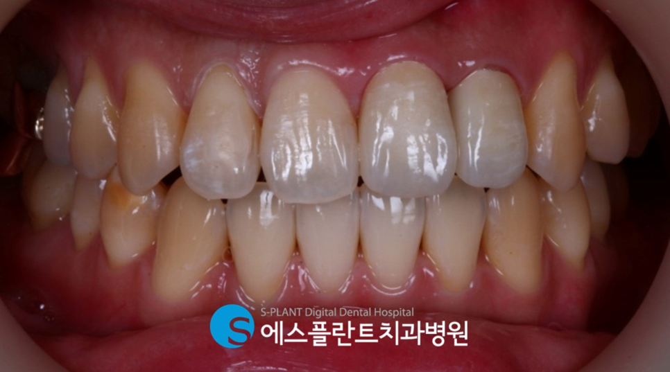 강남 오래된 앞니 보철물 치료는 에스플란트치과병원에서 관련 이미지 5
