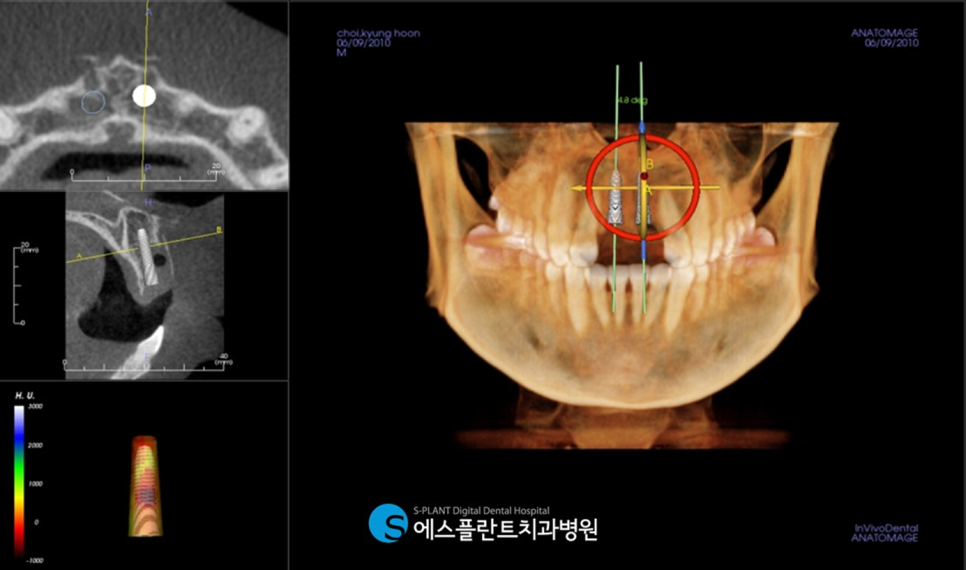 아름다운 미소를 위한 앞니 임플란트는 압구정로데오 에스플란트 치과병원에서 관련 이미지 5