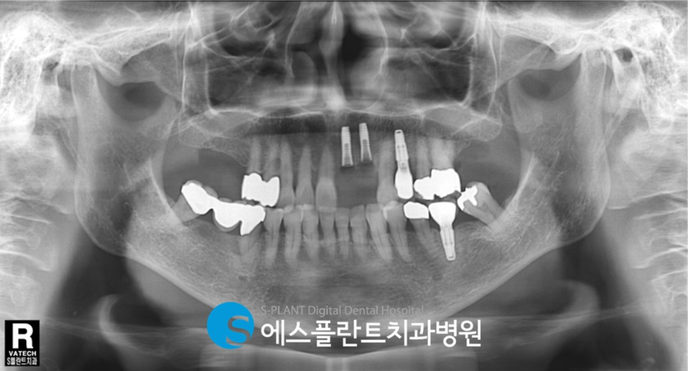 압구정 임플란트 잘하는 치과, 앞니 치관치근 파절 인한 임플란트 수술이 가능한 에스플란트치과병원 관련 이미지 3