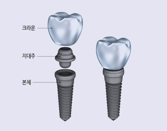 임플란트 꼼꼼한 치료계획을 통해 안전하게 진행해야하니까 [에스플란트 치과병원] 관련 이미지 2
