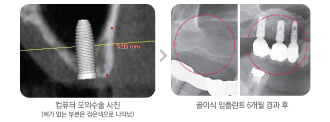 [뼈이식 임플란트] 임플란트잘하는치과, 잇몸 뼈 이식 꼭 해야만 하나요? 관련 이미지 3