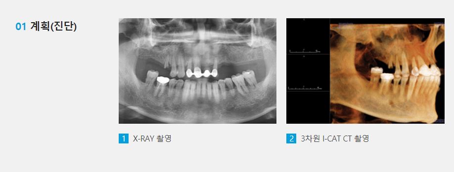 임플란트, 나에게 딱 맞는 가이드를 통해 보다 안전하게 [에스플란트 치과병원] 관련 이미지 5