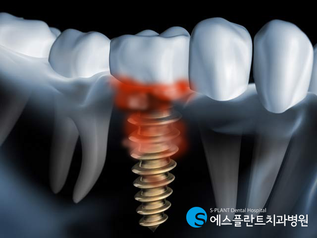 임플란트 오래쓰는법 생각보다 간단해요. 관련 이미지 2