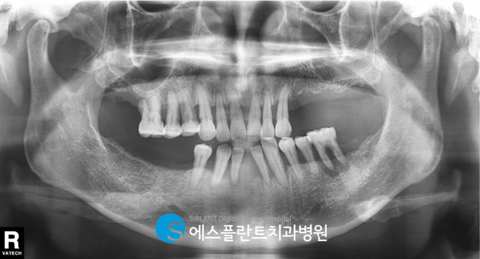 임플란트 잘하는 치과, 에스플란트 치과병원의 임플란트 모의수술과 가이드 제작으로 안전하게 관련 이미지 4