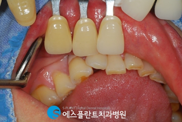 바쁜 현대인을 위한 즉시기능임플란트! 관련 이미지 5