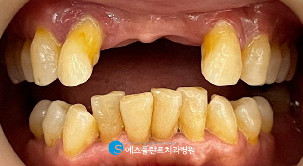 심한 골흡수가 있는 전치부 임플란트 잘하는 강남치과, 에스플란트치과병원 관련 이미지 1