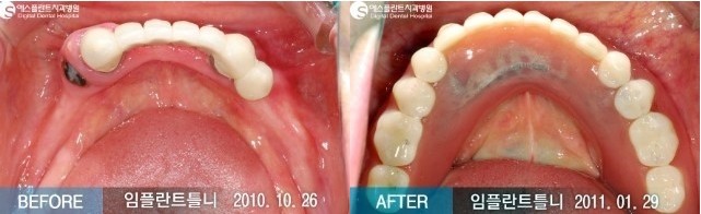 [임플란트후기] 뼈이식 임플란트, 임플란트 틀니 전/후 Story 임플란트 CASE 관련 이미지 3