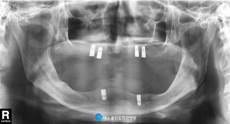 임플란트와 틀니의 장점만 모은 임플란트틀니 관련 이미지 5