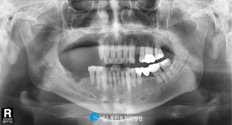 저작기능의 핵심, 어금니 임플란트 식립에는 압구정 에스플란트 치과병원의 가이드 임플란트 관련 이미지 2