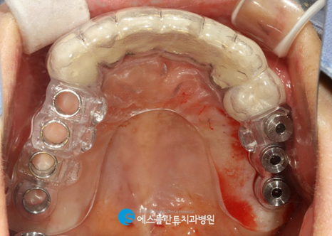 압구정로데오역치과 임플란트 잘하는 치과, 에스플란트 치과병원에서 실제로 사용하는 가이드 임플란트란?! 관련 이미지 7