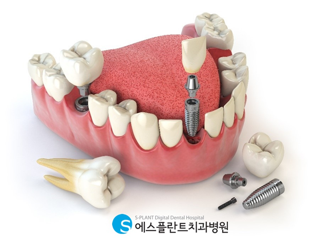 임플란트 치료과정과 주의사항 관련 이미지 6