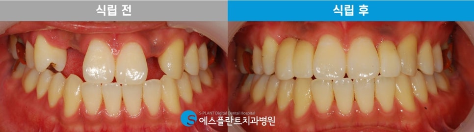 강남 임플란트 잇몸뼈 부족 시, 에스플란트 치과병원의 골이식 임플란트(GBR)로 관련 이미지 7