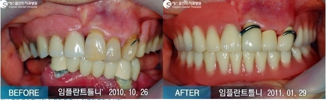[임플란트후기] 뼈이식 임플란트, 임플란트 틀니 전/후 Story 임플란트 CASE 관련 이미지 2