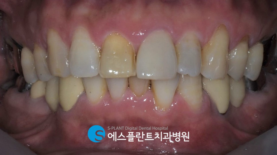 앞니 치아 컴플렉스를 해결하고 싶다면?! 앞구정로데오역 에스플란트치과에서 관련 이미지 2