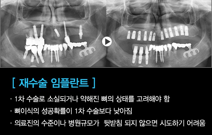 임플란트, 나에게 맞는 임플란트치료를 확인하세요. 관련 이미지 7
