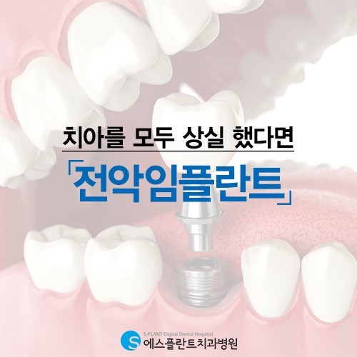 전악임플란트, 새로운 삶 얻어. – 에스플란트치과병원 관련 이미지 1