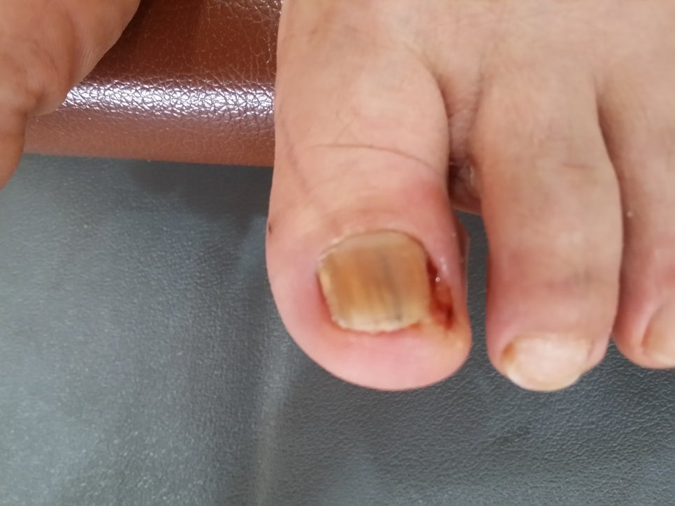 발톱무좀과 흑색종 손발톱 관련 이미지 3
