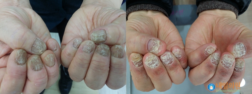 [내일의원] 발톱무좀 레이저 치료 안내 및 정보 관련 이미지 13