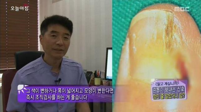 [내일의원] 손톱 발톱에 검은 선 "흑색종" 관련 이미지 8