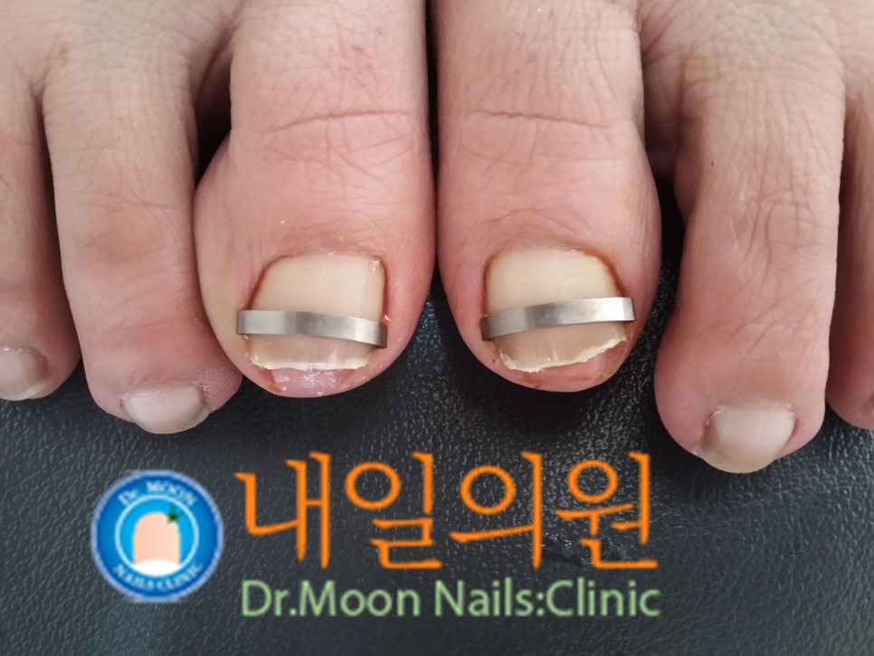 [내일의원] 내성발톱 치료 및 정보안내 관련 이미지 1