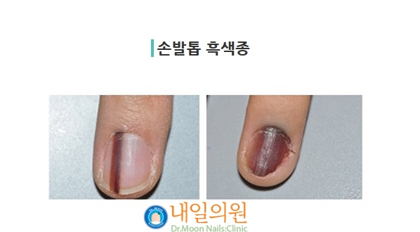 [내일의원] 손톱 발톱에 검은 선 "흑색종" 관련 이미지 1