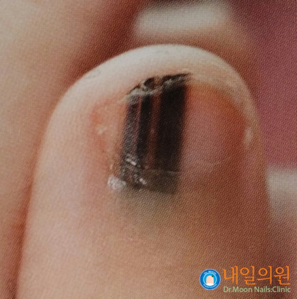 [내일의원] 손톱 발톱에 검은 선 "흑색종" 관련 이미지 11