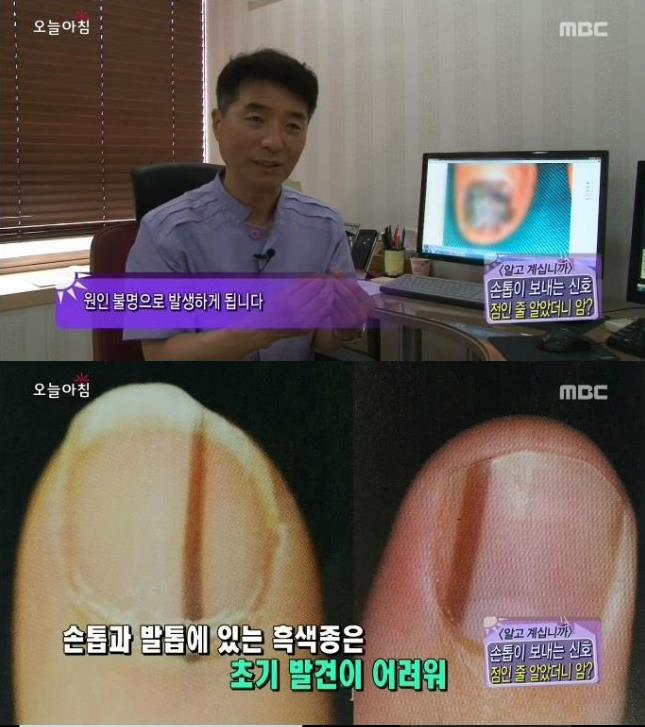 [내일의원] 손톱 발톱에 검은 선 "흑색종" 관련 이미지 3