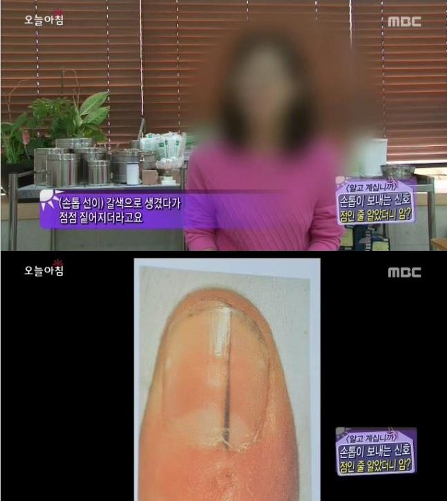 [내일의원] 손톱 발톱에 검은 선 "흑색종" 관련 이미지 5