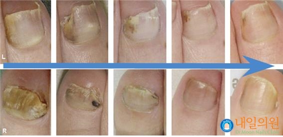 [내일의원] 발톱무좀 레이저 치료 안내 및 정보 관련 이미지 6