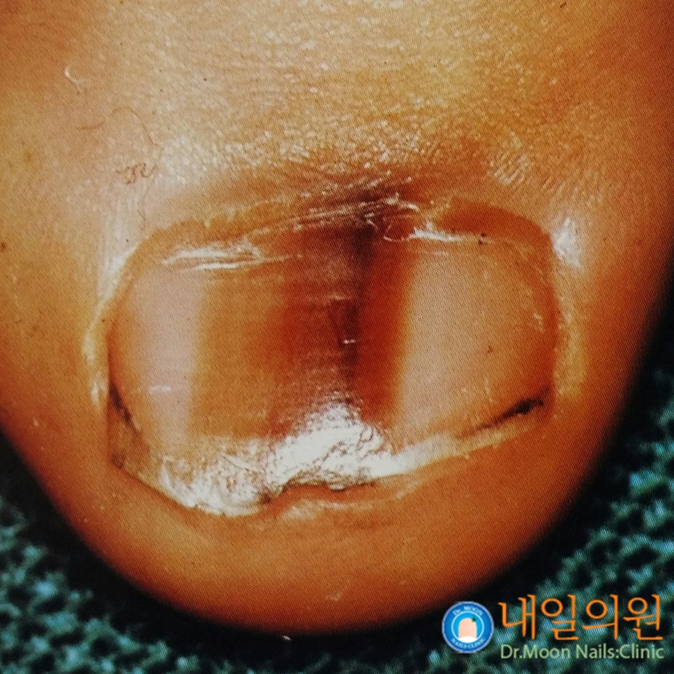 [내일의원] 손톱 발톱에 검은 선 "흑색종" 관련 이미지 10