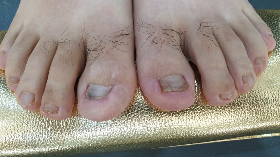 발톱무좀과 내성발톱70(콜로세움) 관련 이미지 17