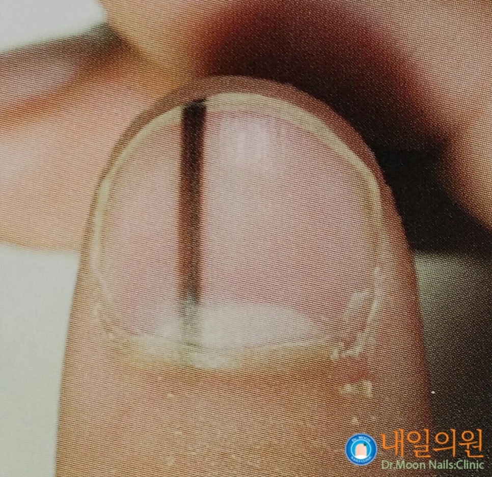 [내일의원] 손톱 발톱에 검은 선 "흑색종" 관련 이미지 13