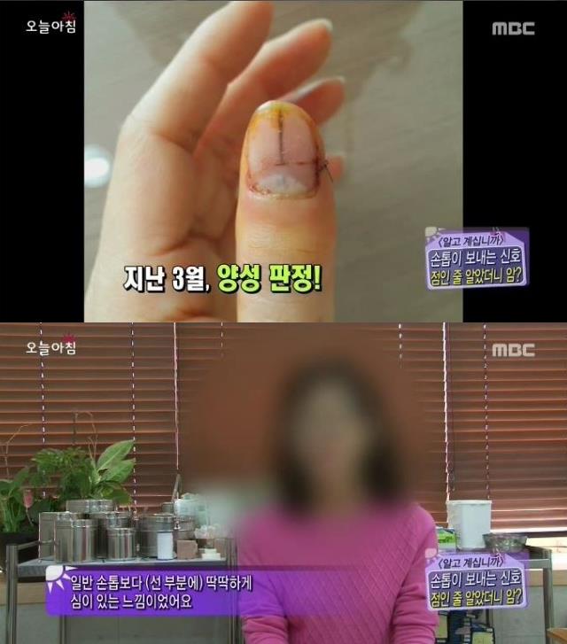 [내일의원] 손톱 발톱에 검은 선 "흑색종" 관련 이미지 6