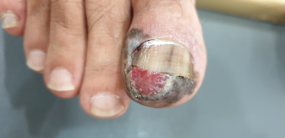 Nail Melanoma and Melanonychia (& Byeonsanbando) image 13