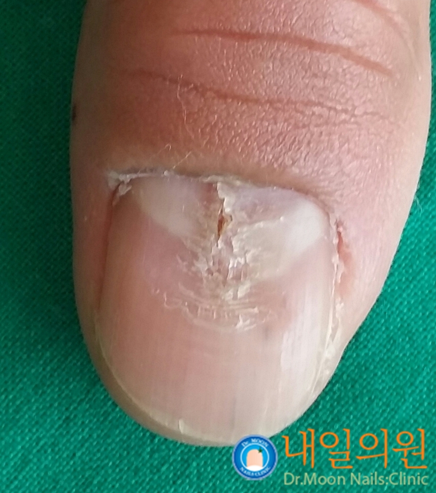 [내일의원] 손톱종양, 발톱종양 및 이식술 성형술안내 관련 이미지 5
