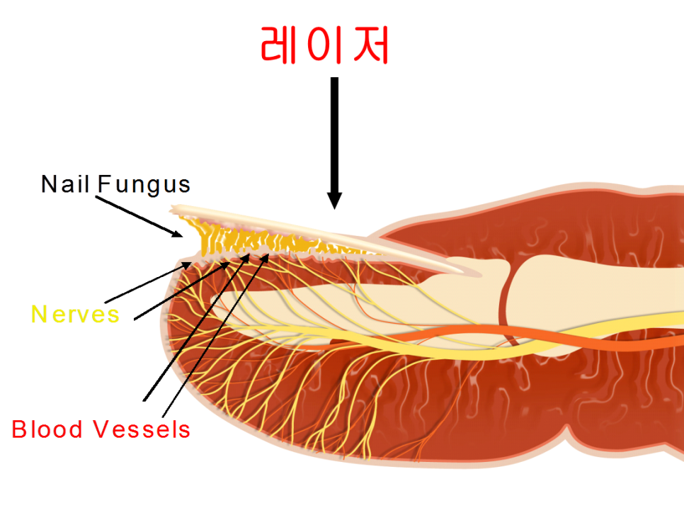 [내일의원] 발톱무좀 레이저 치료 안내 및 정보 관련 이미지 3
