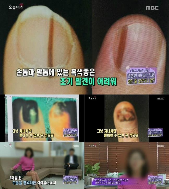 [내일의원] 손톱 발톱에 검은 선 "흑색종" 관련 이미지 4