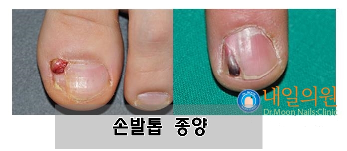 [내일의원] 손톱종양, 발톱종양 및 이식술 성형술안내 관련 이미지 1