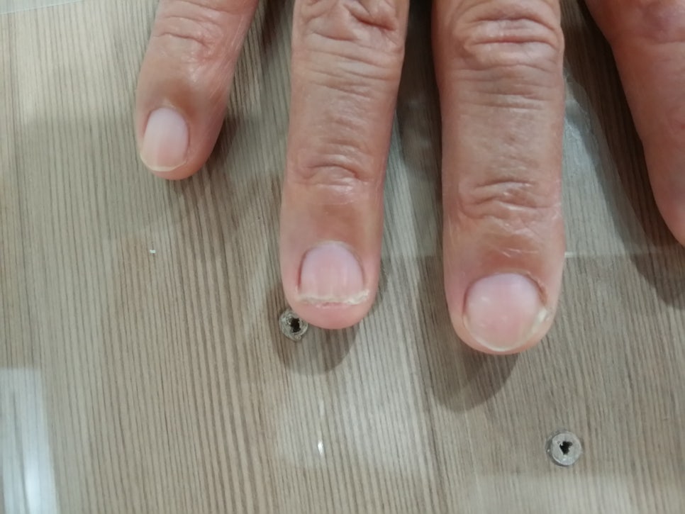 손톱 박리증(발톱무좀,내성발톱,손톱흑색종) 관련 이미지 2
