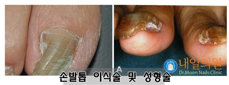 [내일의원] 손톱종양, 발톱종양 및 이식술 성형술안내 관련 이미지 6