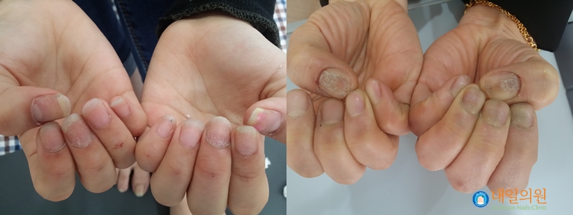 [내일의원] 발톱무좀 레이저 치료 안내 및 정보 관련 이미지 12